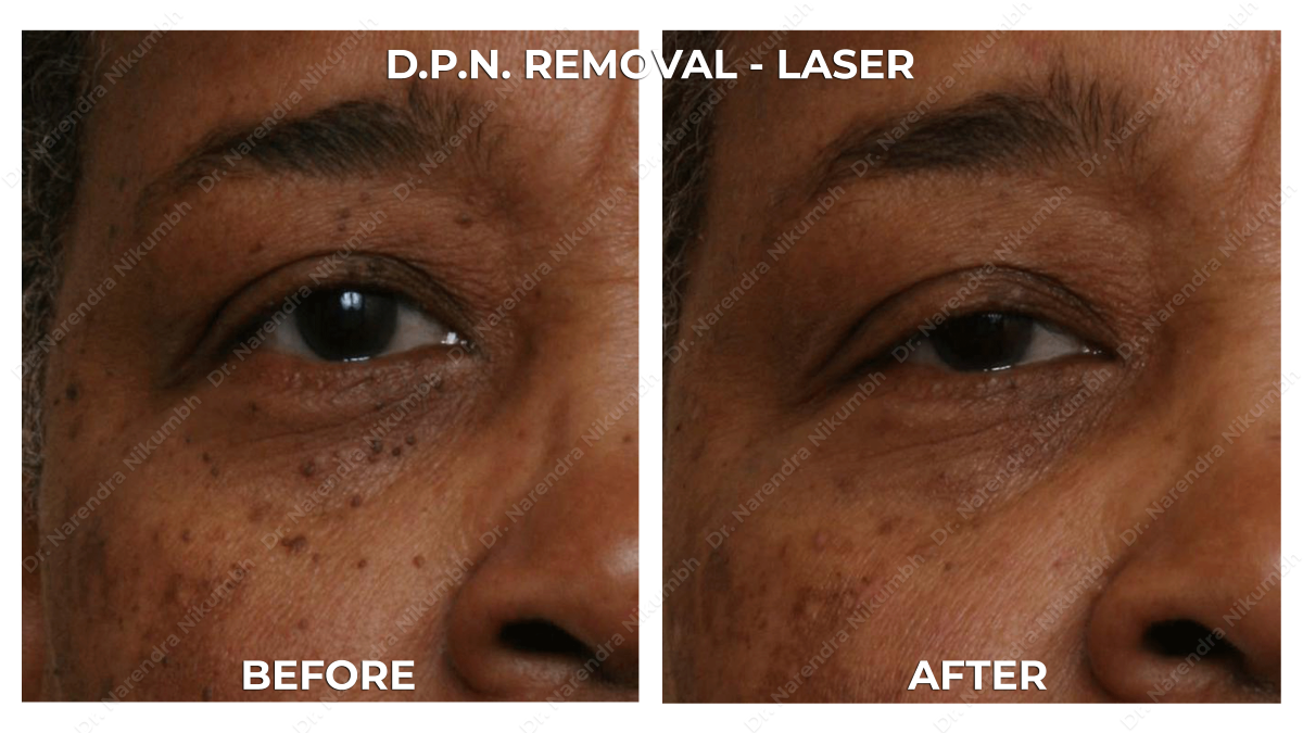 Mole removal treatment by Dr Narendra Nikumbh