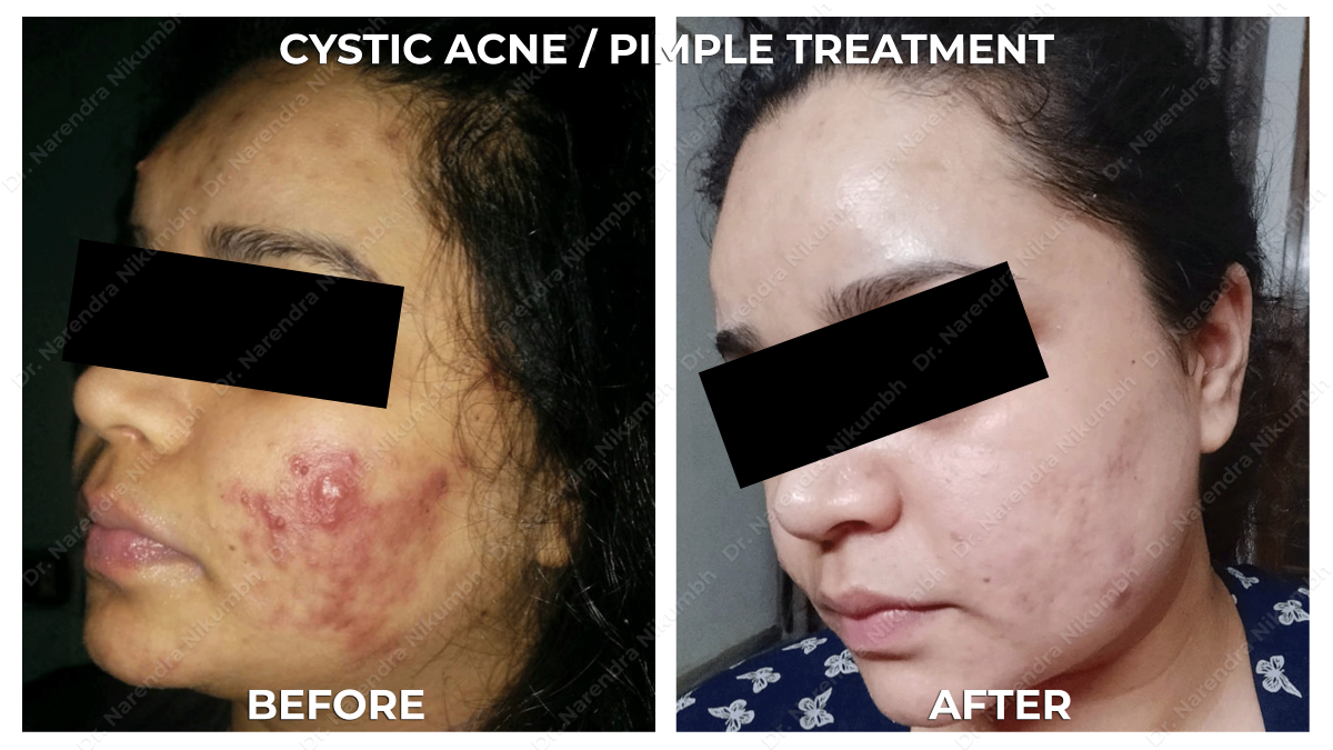 Acne / Pimple Treatment by Dr Narendra Nikumbh