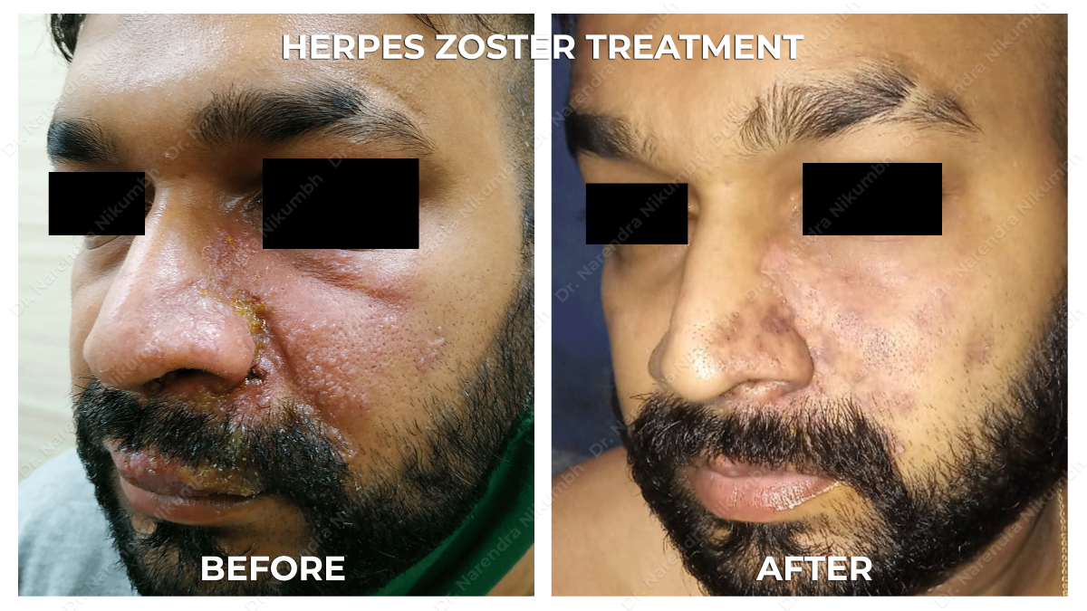 Herpes Zoster Treatment by Dr Narendra Nikumbh