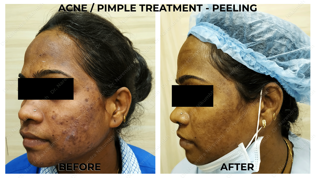 Acne / Pimple Treatment by Dr Narendra Nikumbh