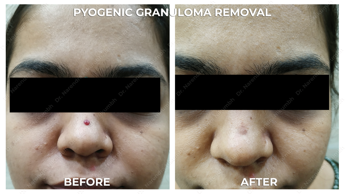 Mole Removal Treatment by Dr Narendra Nikumbh