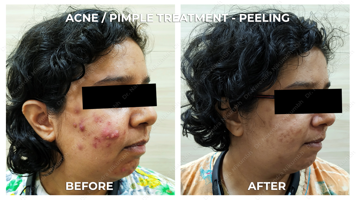 Acne / Pimple Treatment by Dr Narendra Nikumbh