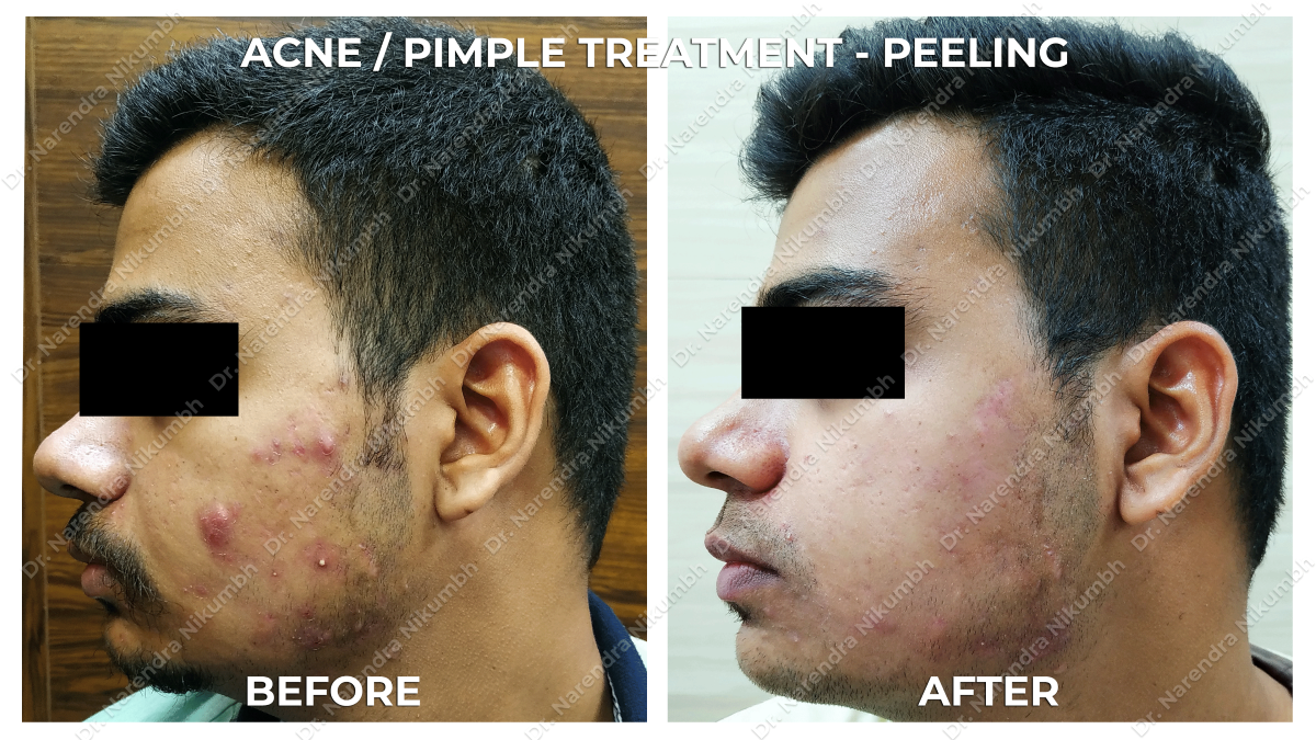 Acne / Pimple Treatment by Dr Narendra Nikumbh