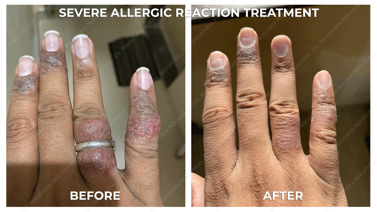 Allergy Treatment by Dr Narendra Nikumbh