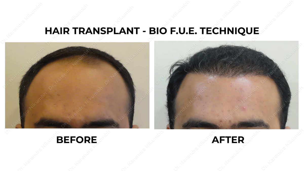 Best Hair Transplant Clinic in Thane