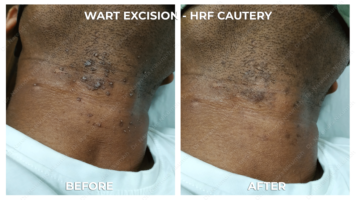 Wart Removal Treatment by Dr Narendra Nikumbh
