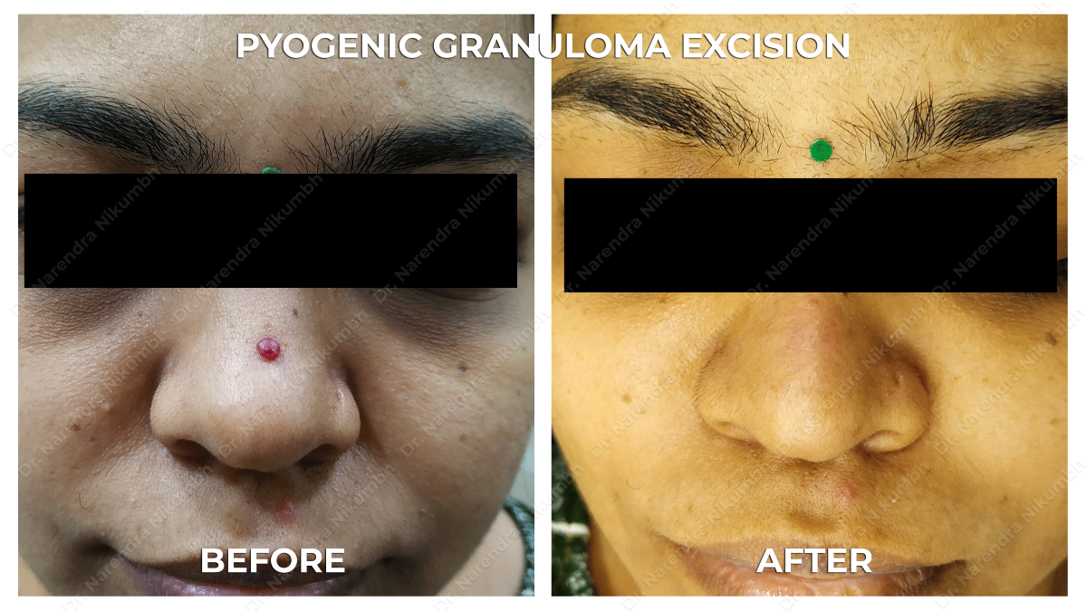 Mole Removal Treatment by Dr Narendra Nikumbh