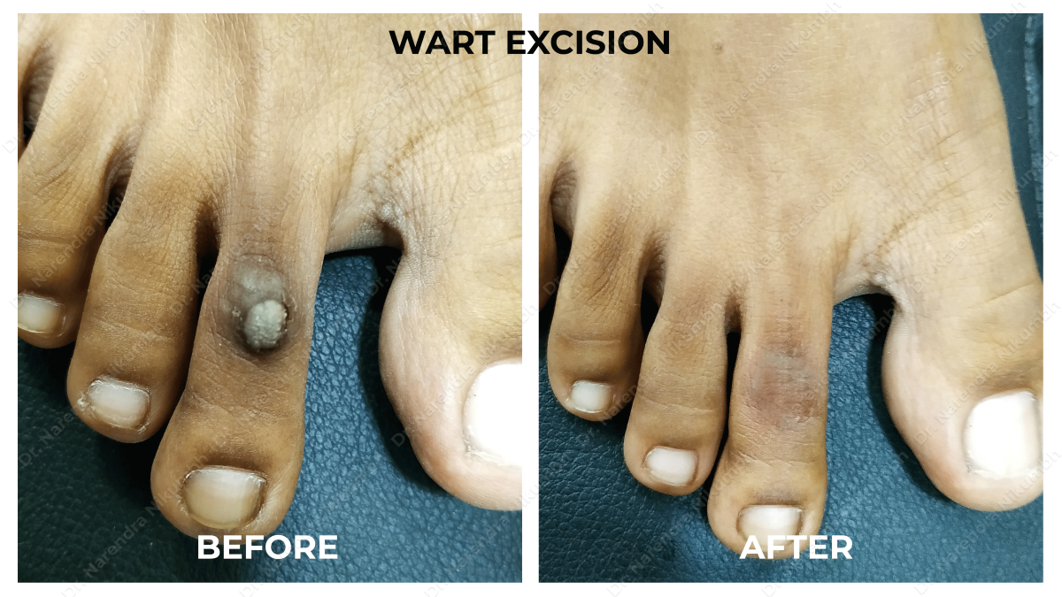 Wart Removal by Dr Narendra Nikumbh