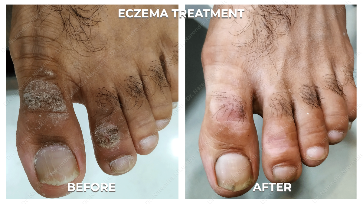 Eczema Treatment by Dr Narendra Nikumbh