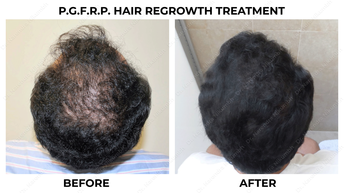 165 Dr Narendra Nikumbh Best Dermatologist in Thane