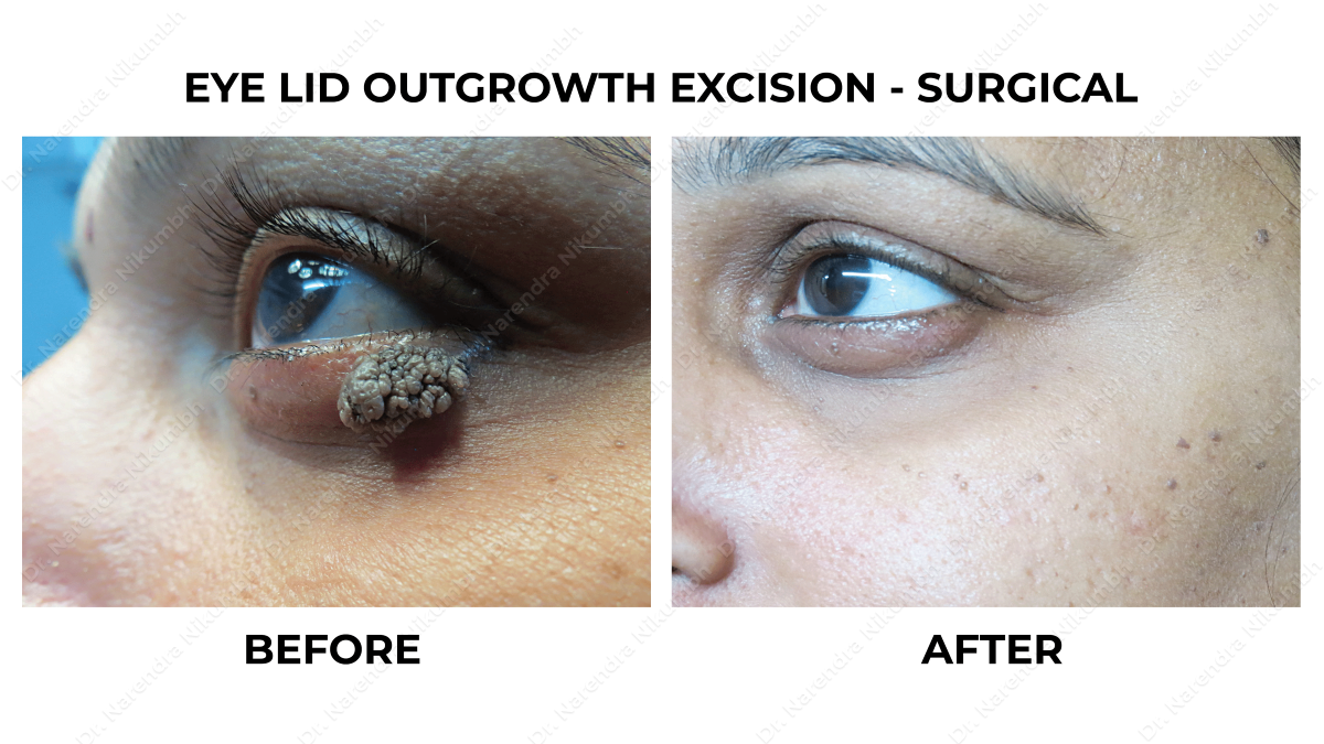 Wart Removal Treatment by Dr Narendra Nikumbh