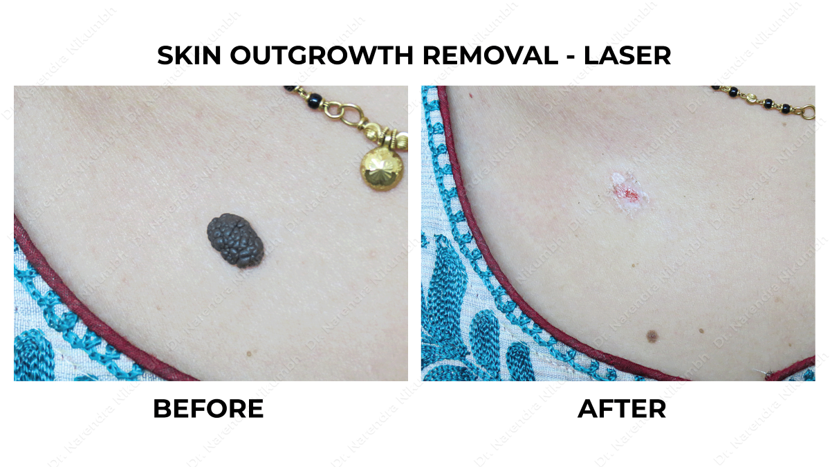 Wart Removal Treatment by Dr Narendra Nikumbh