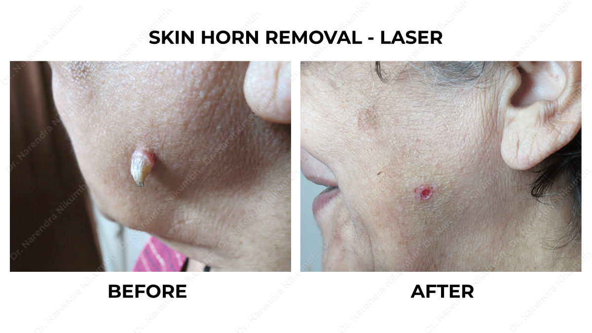 Wart Removal Treatment by Dr Narendra Nikumbh