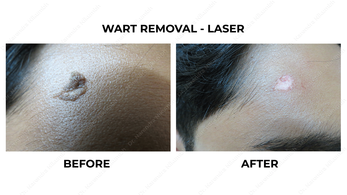 Wart Removal Treatment by Dr Narendra Nikumbh