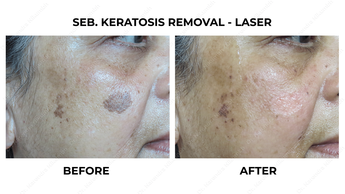 Melasma Treatment by Dr Narendra Nikumbh