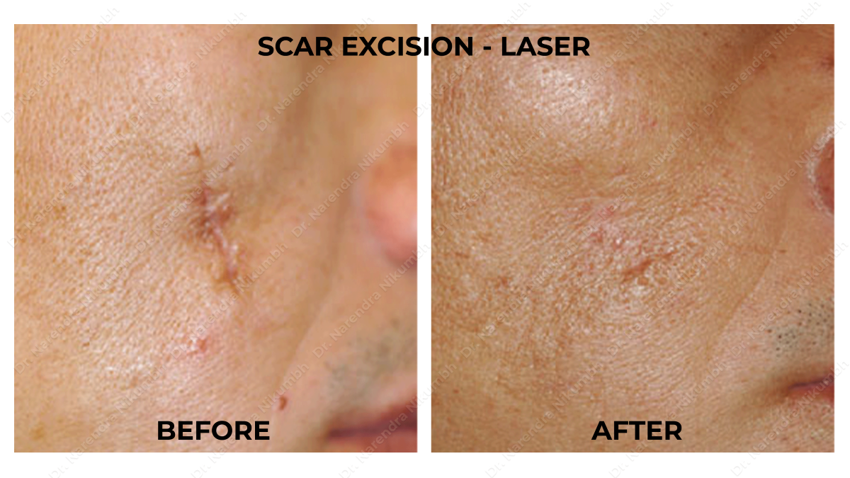 Scar Treatment by Dr Narendra Nikumbh