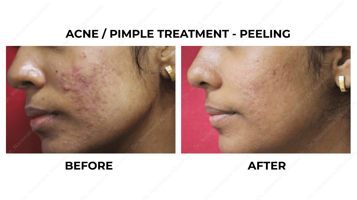 Acne /Pimple Treatment by Dr Narendra Nikumbh