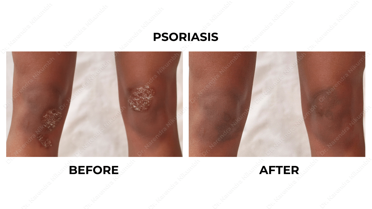 Psoriasis Treatment by Dr Narendra Nikumbh
