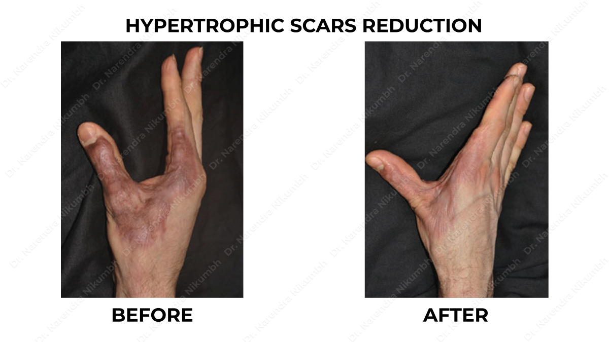 Hypertrophic Scar Treatment by Dr Narendra Nikumbh