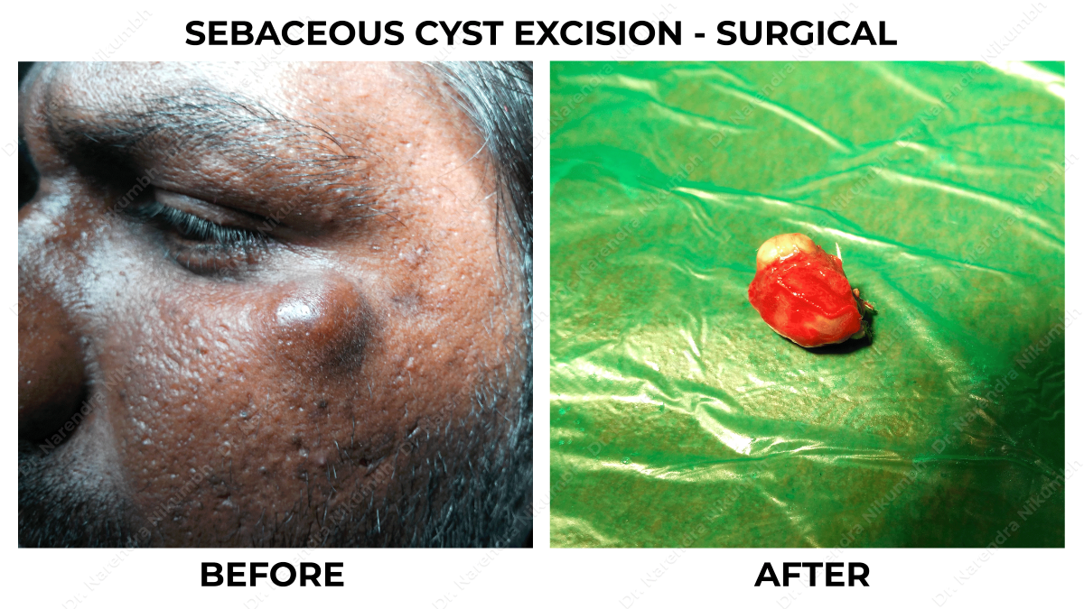 Cyst Excision Surgery by Dr Narendra Nikumbh