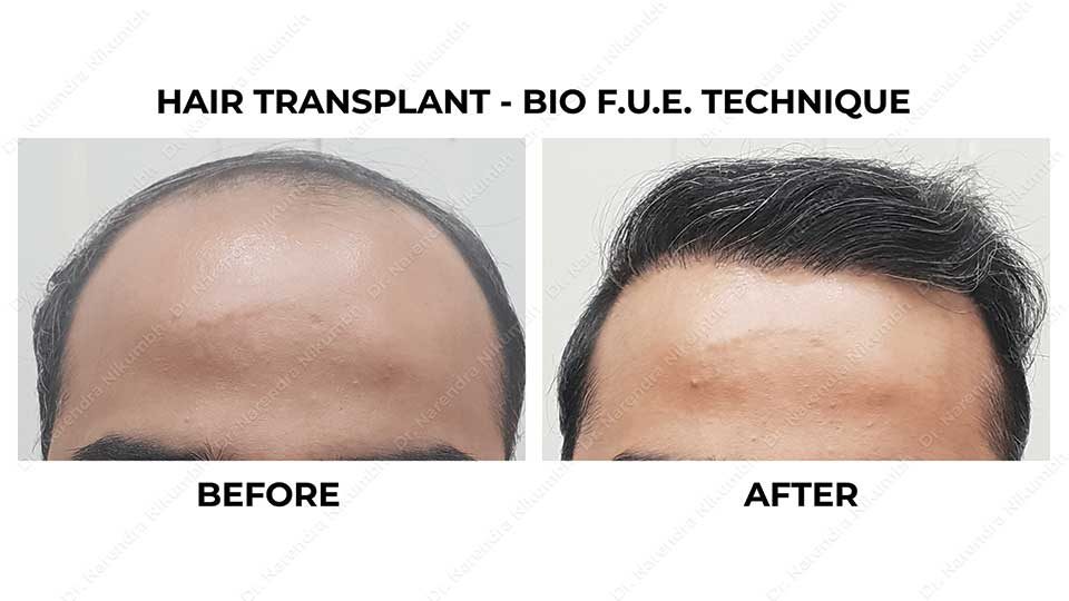 Dr Narendra Nikumbh Hair Transplant Surgery Result Before and After