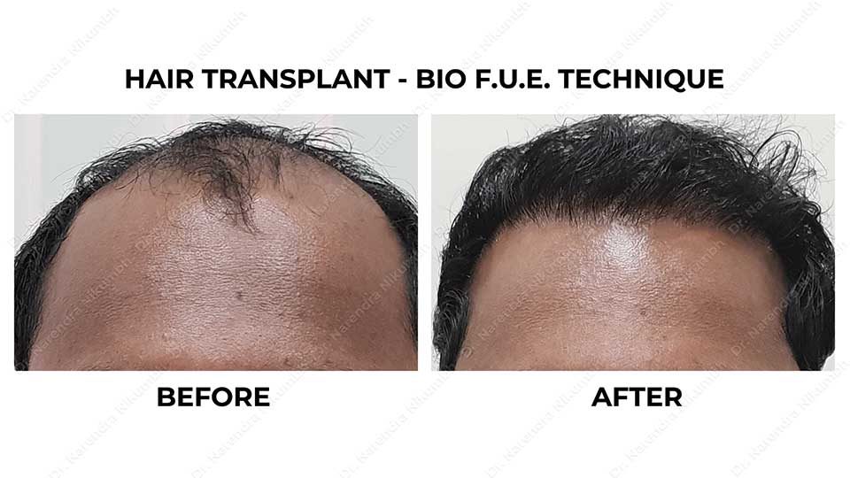 Dr Narendra Nikumbh performd Hair Transplant Surgery Result Before and After